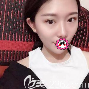 北京艺星医疗美容医院眼综合案例 北京艺星医疗美容医院眼综合案例