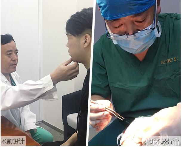 南京美贝尔医生做厚唇改薄手术+假体垫下巴整形中
