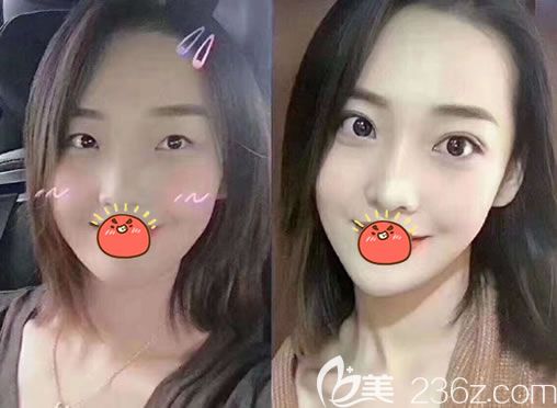 宁波薇琳医美<!--<i data=20240703-sp></i>-->双眼皮隆鼻案例 宁波薇琳医美<!--<i data=20240703-sp></i>-->双眼皮隆鼻案例