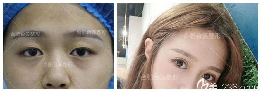 合肥台美丽格整形好不好？台美叶凡眼综合真人案例验证实力