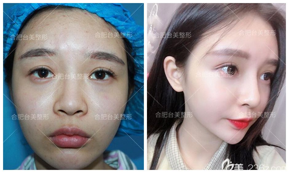 合肥台美丽格整形正规吗？穆威院长生态隆鼻鼻综合案例来验证