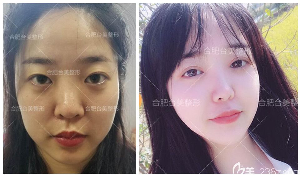 合肥哪家开双眼皮好？公布合肥台美丽格王新磊眼综合案例效果对比图