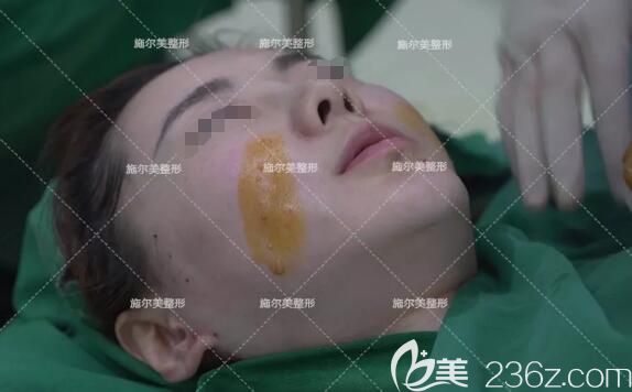 做线雕微整术前面部消毒