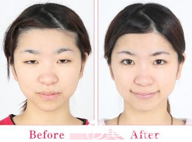日本中央整形做埋线双眼皮正面前后对比 日本中央整形做埋线双眼皮正面前后对比