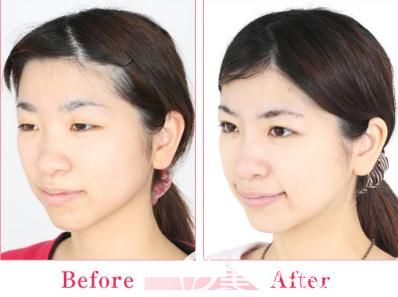 怂恿闺蜜陪我到日本中央整形做埋线双眼皮后 给大家分享四组对比图看效果是不是自然的不像话