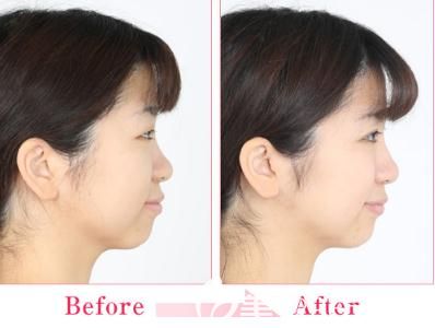 日本中央整形做埋线双眼皮侧面 日本中央整形做埋线双眼皮侧面