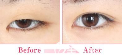 日本中央整形做埋线双眼皮单眼细节对比