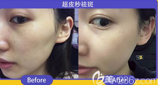福州台江陈丽萍激光祛斑三个月对比效果 福州台江陈丽萍激光祛斑三个月对比效果