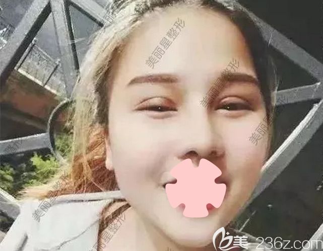 我在南宁美丽星做双眼皮和隆鼻第7天拆线照片 我在南宁美丽星做双眼皮和隆鼻第7天拆线照片
