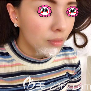 <!--<i data=20240703-sp></i>-->医生给我做玻尿酸垫下巴当天敷麻样子