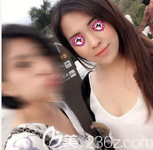 北京惠合嘉美医院玻尿酸垫下巴案例