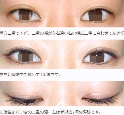 西山美容形成外科医院双眼皮手术