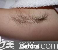 ALETHEIA美容皮肤科脱毛前 ALETHEIA美容皮肤科脱毛前