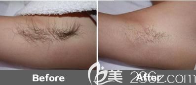 ALETHEIA美容皮肤科脱毛前后对比 ALETHEIA美容皮肤科脱毛前后对比