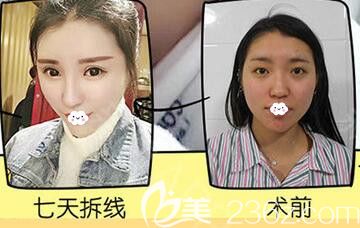 武汉美丽力量俞静硅胶隆鼻术后7天恢复效果与术前对比图