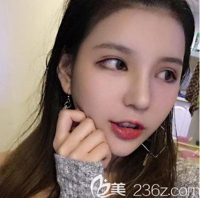 广州艺美李闯隆鼻案例7天拆线