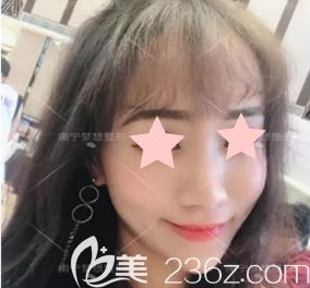  看了自己在南宁梦想整形打瘦脸除皱瘦脸+玻尿酸前后对比照片，感觉挺靠谱