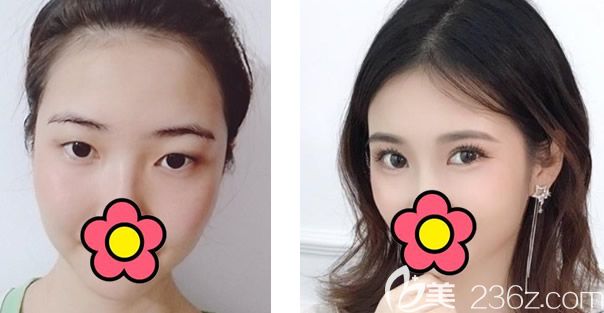 兰州时光相伴张晓萍院长全切双眼皮+开眼角<span style=