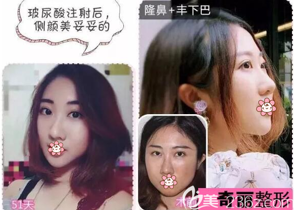 攀枝花奇丽隆鼻丰下巴真实案例