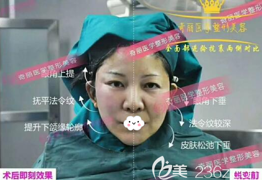 线雕提升抗衰术中两侧脸对比