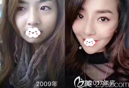 攀枝花奇丽瘦脸+玻尿酸丰下巴术后效果