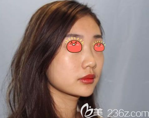 宁波薇琳医美做假体隆鼻前 宁波薇琳医美做假体隆鼻前