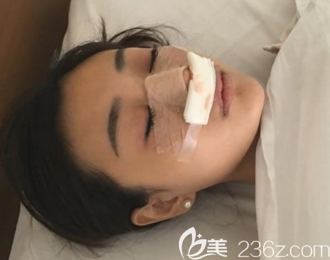 宁波薇琳医院做隆鼻即刻<span style= 宁波薇琳医院做隆鼻即刻<span style=