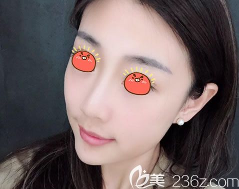 宁波薇琳整形做隆鼻2周<span style= 宁波薇琳整形做隆鼻2周<span style=