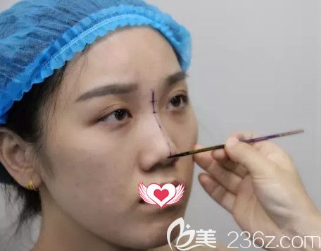 荆万里医生为我做鼻综合术前设计 荆万里医生为我做鼻综合术前设计