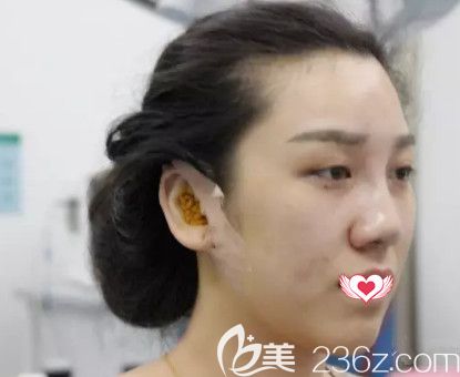 荆万里医生为我做鼻综合术后鼻子微肿 荆万里医生为我做鼻综合术后鼻子微肿