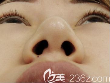 水之森鼻尖缩小术前