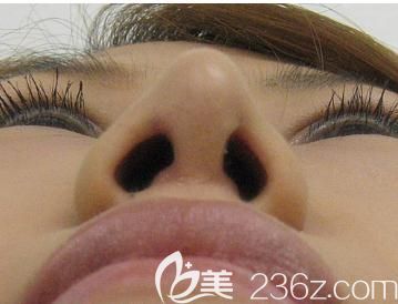 水之森鼻尖缩小术后