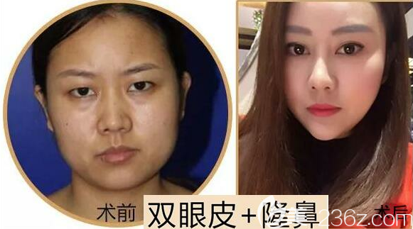 攀枝花奇丽双眼皮隆鼻手术效果展示