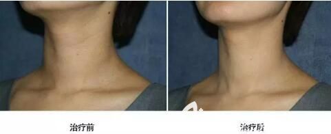 海南华美微针套组祛颈纹真人前后对比效果