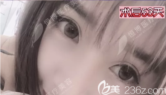 帕克法双眼皮恢复2个月照片 帕克法双眼皮恢复2个月照片