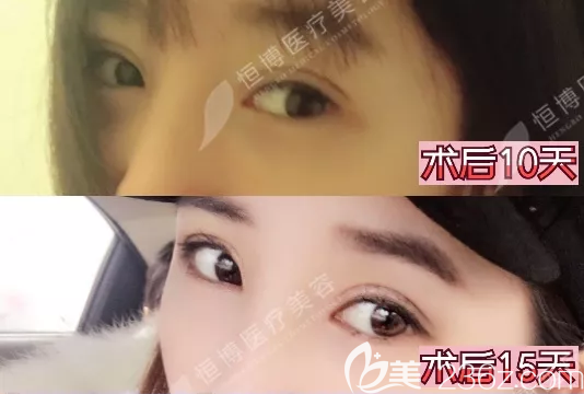 成都恒博双眼皮术后半个月恢复效果图 成都恒博双眼皮术后半个月恢复效果图