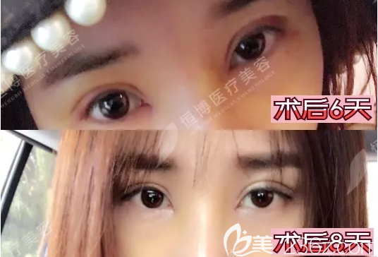 双眼皮开眼角拆线后效果 双眼皮开眼角拆线后效果