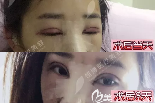 成都恒博切开双眼皮术后即刻 成都恒博切开双眼皮术后即刻