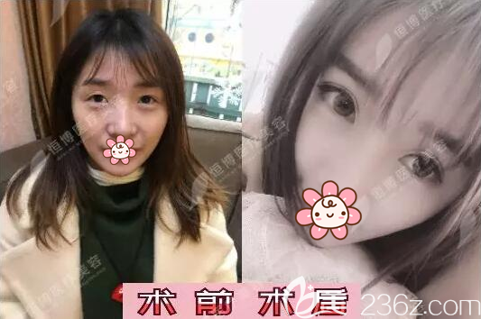 成都恒博双眼皮开眼角术前术后效果对比 成都恒博双眼皮开眼角术前术后效果对比