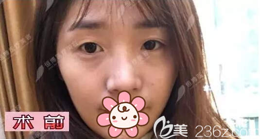 在<!--<i data=20240703-sp></i>-->做双眼皮手术前的照片 在<!--<i data=20240703-sp></i>-->做双眼皮手术前的照片