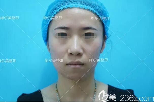 做玻尿酸丰苹果肌术前面部呆板 做玻尿酸丰苹果肌术前面部呆板