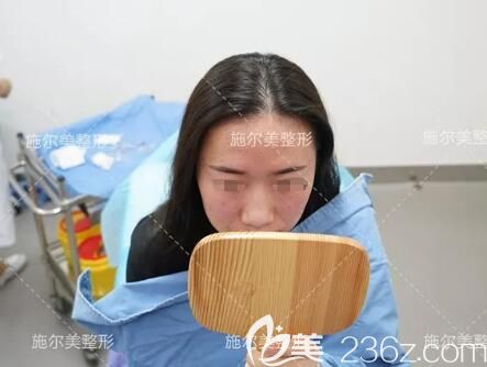 刚做完润致玻尿酸玻尿酸丰苹果肌效果 刚做完润致玻尿酸玻尿酸丰苹果肌效果