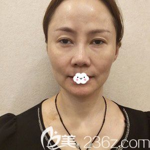 武汉美基元医疗美容医院梁琼做线雕埋线提升案例 武汉美基元医疗美容医院梁琼做线雕埋线提升案例