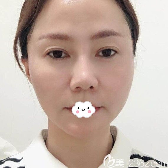 武汉美基元埋线提升术后第1天 武汉美基元埋线提升术后第1天