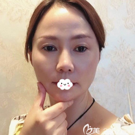 武汉美基元面部年轻化真人案例 武汉美基元面部年轻化真人案例