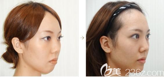 日本水之森做假体垫下巴正侧面对比 日本水之森做假体垫下巴正侧面对比