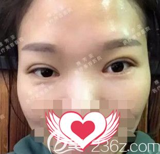 雅芳亚整形院长王文明做切开双眼皮术后7天拆线