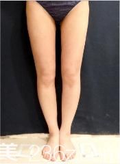 日本吸脂医生有哪些?水之森末永裕信给我逆天大长腿