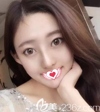 丁庆丰院长做鼻综合术后15天鼻子完全消肿 丁庆丰院长做鼻综合术后15天鼻子完全消肿