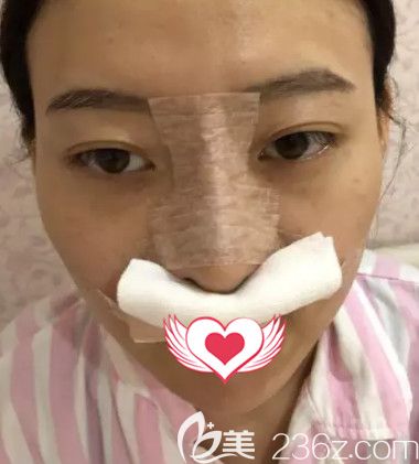 石家庄雅芳亚做自体软骨隆鼻术后鼻子微肿 石家庄雅芳亚做自体软骨隆鼻术后鼻子微肿